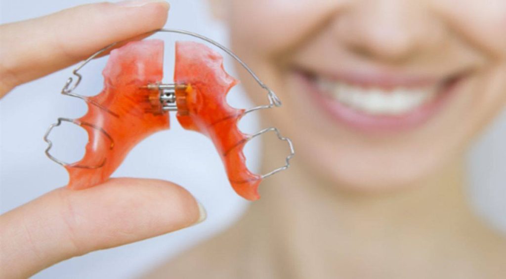 aparat dentar mobil